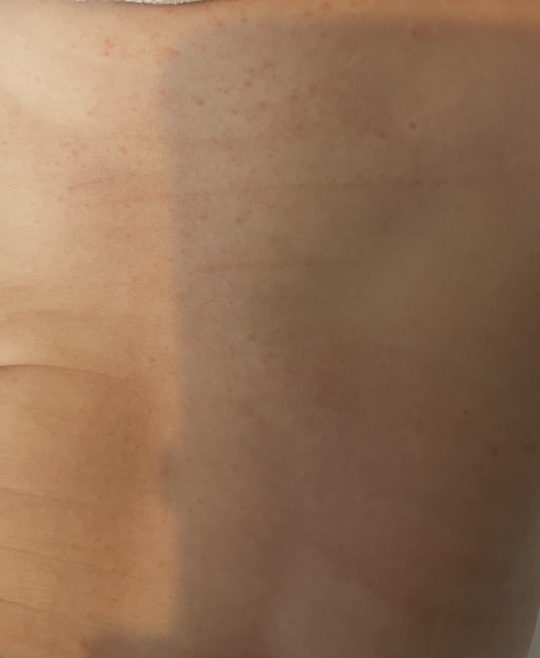 Rash on baby