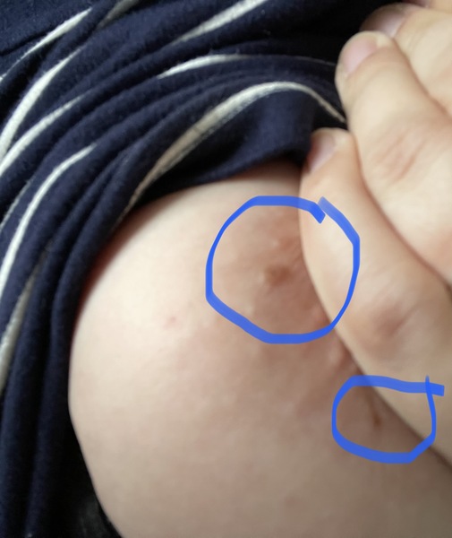 New mole on areola