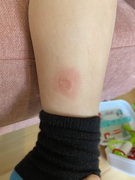 Rash/bite/something else