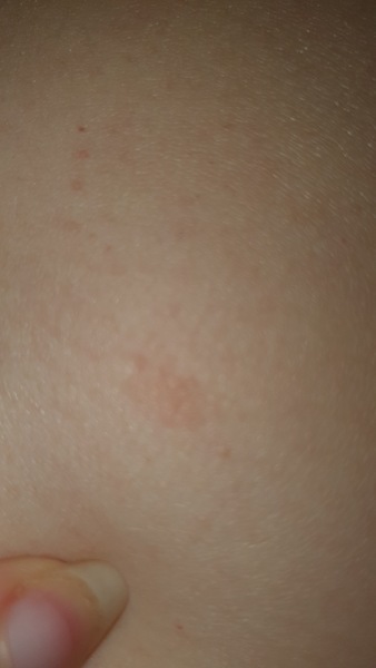 Dry patches / rash