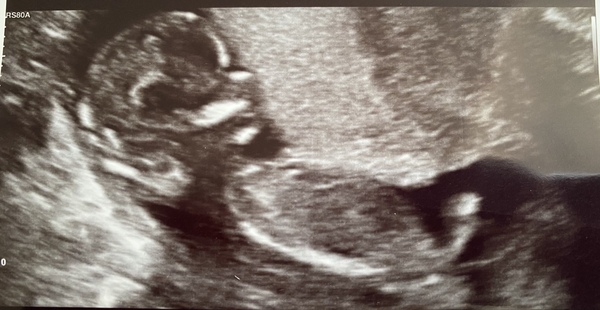 14 weeks - boy or girl? Guesses welcome!