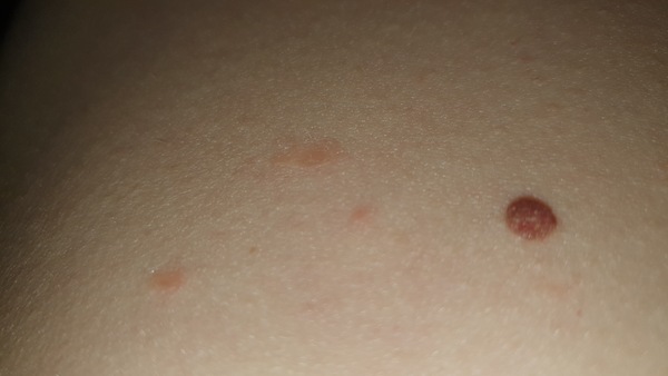 Dry patches / rash