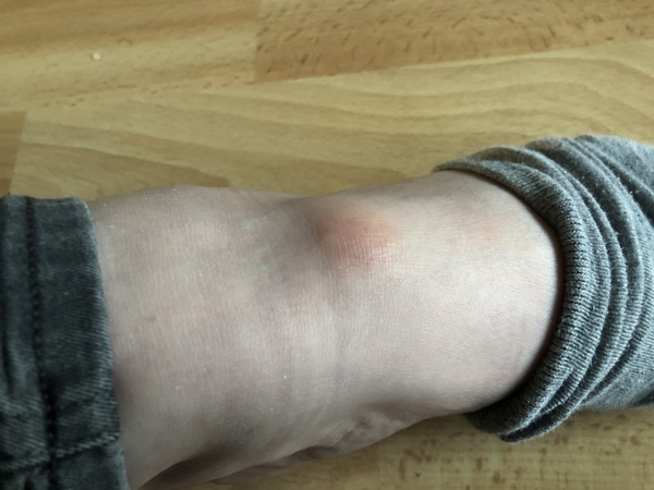 Anyone have any ideas what this lump is on my foot