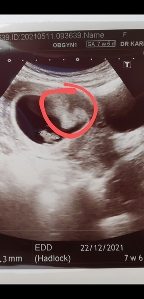 Can anyone tell where the placenta is here (10+5)?