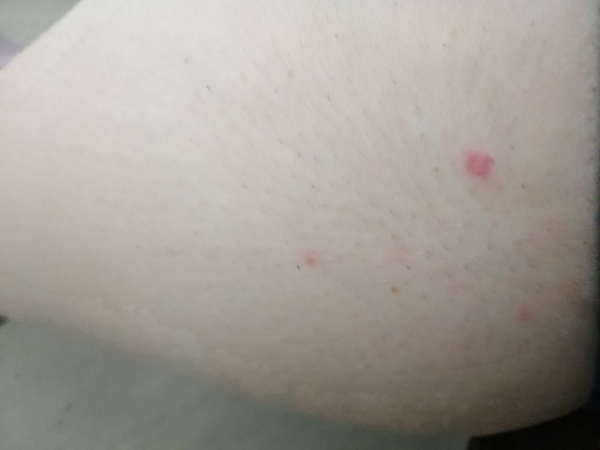 What is eating me???