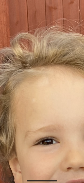 Pigmentation marks on baby