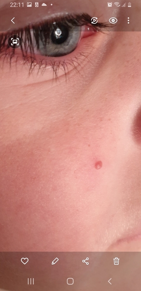 Lump on ds face