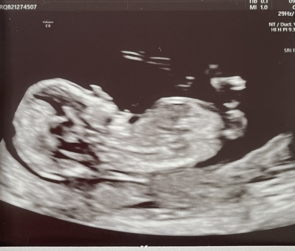 IVF March/April thread 2