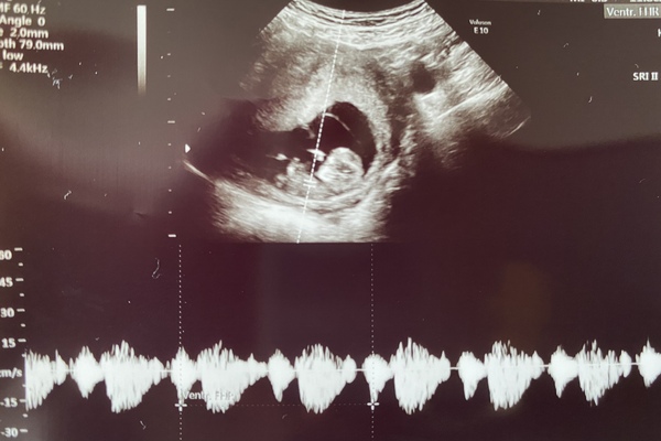 Can anyone tell where the placenta is here (10+5)?