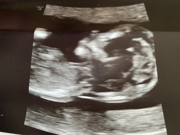 Girl or boy scan ???