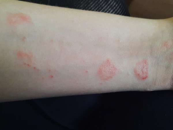 School questioning child over ezcema