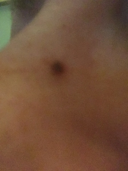 Is this a mole or a blackhead (pic attached)