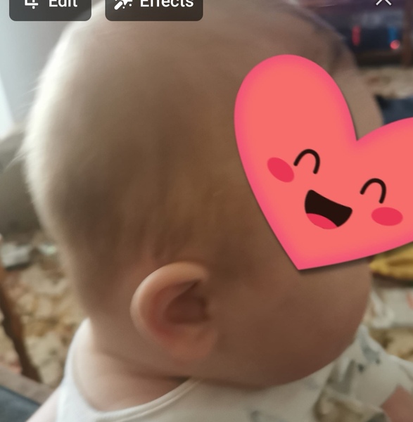 Flat head syndrome