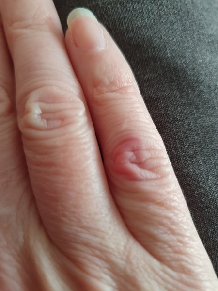 What have I done to my finger?