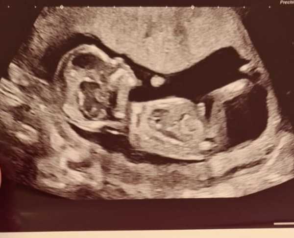 Nub/scull theory 13 weeks+2days