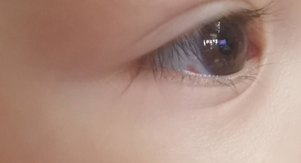 Strange mark on daughters eye