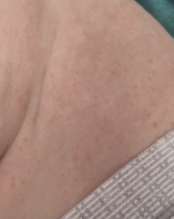 Rash on baby