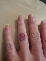 What have I done to my finger?