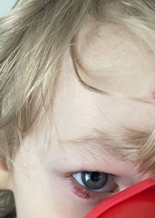 Scabby lump on eyelid (photo)