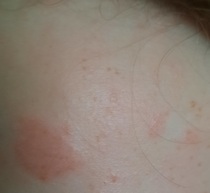 School questioning child over ezcema