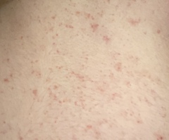 unexplained itchy rash 14 weeks pregnant