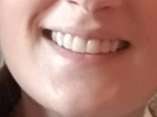 Invisalign