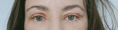 upper blepharoplasty