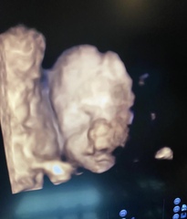 Did doctor miss cleft lip on 25 week scan?