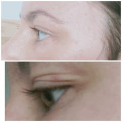 Eyelid strips - has anybody tried them?