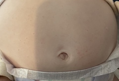 Rash on baby