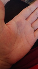 Any doctors about? Watching bruises appear 😱