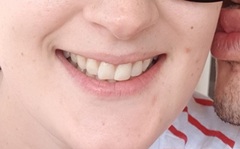 Invisalign