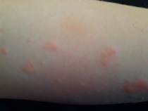 School questioning child over ezcema