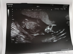 15w scan. Any guesses on sex?