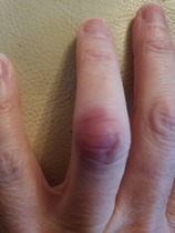 What have I done to my finger?