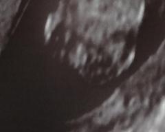 15w scan. Any guesses on sex?