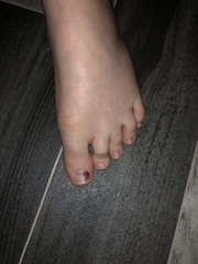 Do these look like bruised toenails?