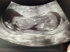 Girl or boy scan ???