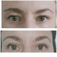 upper blepharoplasty