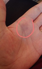 Any doctors about? Watching bruises appear 😱