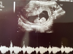 Can anyone tell where the placenta is here (10+5)?