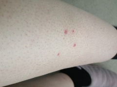 What is eating me???