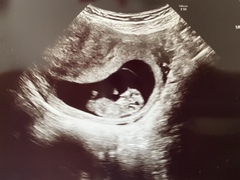 Can anyone tell where the placenta is here (10+5)?