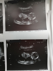 15w scan. Any guesses on sex?