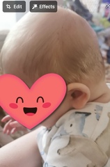 Flat head syndrome