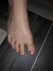 Do these look like bruised toenails?