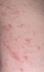 itchy rash 14 weeks pregnant