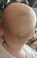 Flat head syndrome