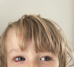 Scabby lump on eyelid (photo)