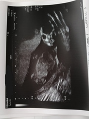 15w scan. Any guesses on sex?